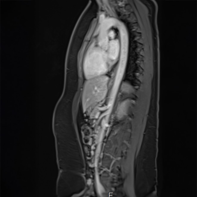 Dr Ebner_Aorta