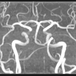 Dr Ebner_intracranielle Gefässe